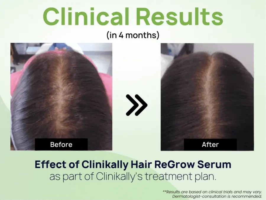 Clinikally Hair ReGrow Serum - Image 5