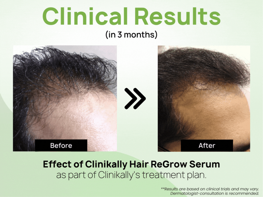 Clinikally Hair ReGrow Serum - Image 6