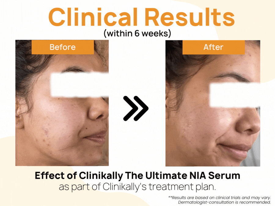Clinikally The Ultimate NIA (10% Niacinamide) Serum - Image 3
